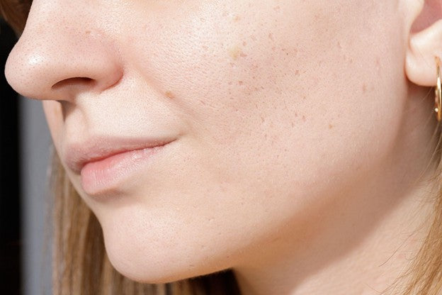 What Causes Atrophic Scars and How Can They Be Treated?