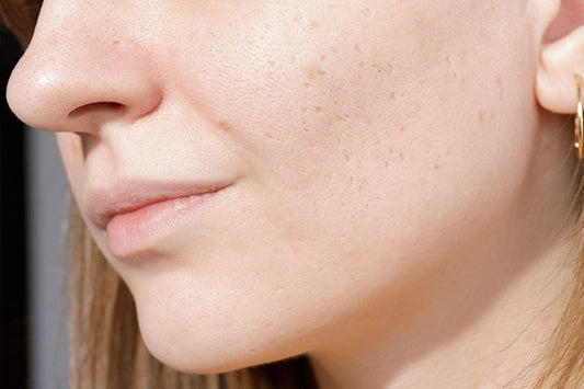 What Causes Atrophic Scars and How Can They Be Treated?
