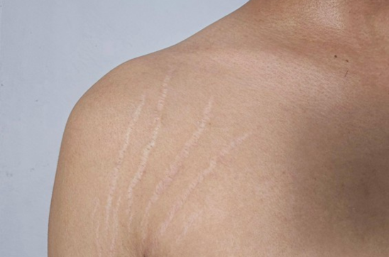 Boxcar Scars Treatment: Best Options for Long-lasting Results