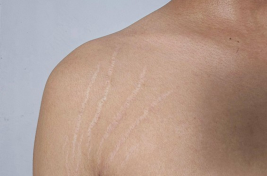 Boxcar Scars Treatment: Best Options for Long-lasting Results