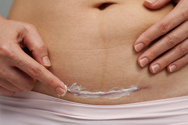 Understanding C-section Scars: Types, Healing, and Treatment Options