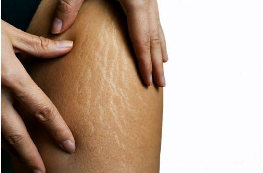 Cellulite vs Stretch Marks: What's the Difference and How to Treat Them?