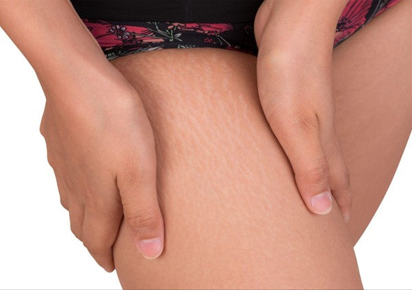 Red Stretch Marks on Thighs: How to Treat and Prevent Them Effectively