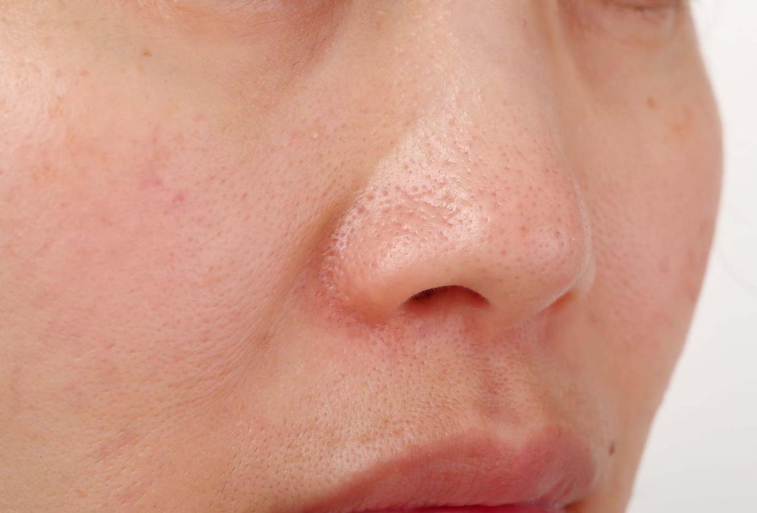 Exploring Open Pores Treatment Options: How Mederma Products Stand Out