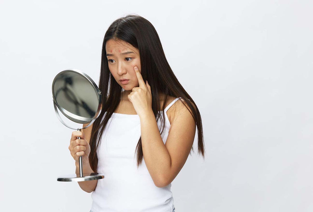 Healing Chicken Pox Scars: Tips and Remedies for Smooth Skin