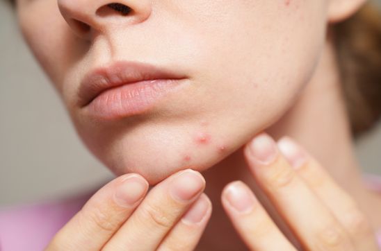 How to Prevent Pimples Before They Start