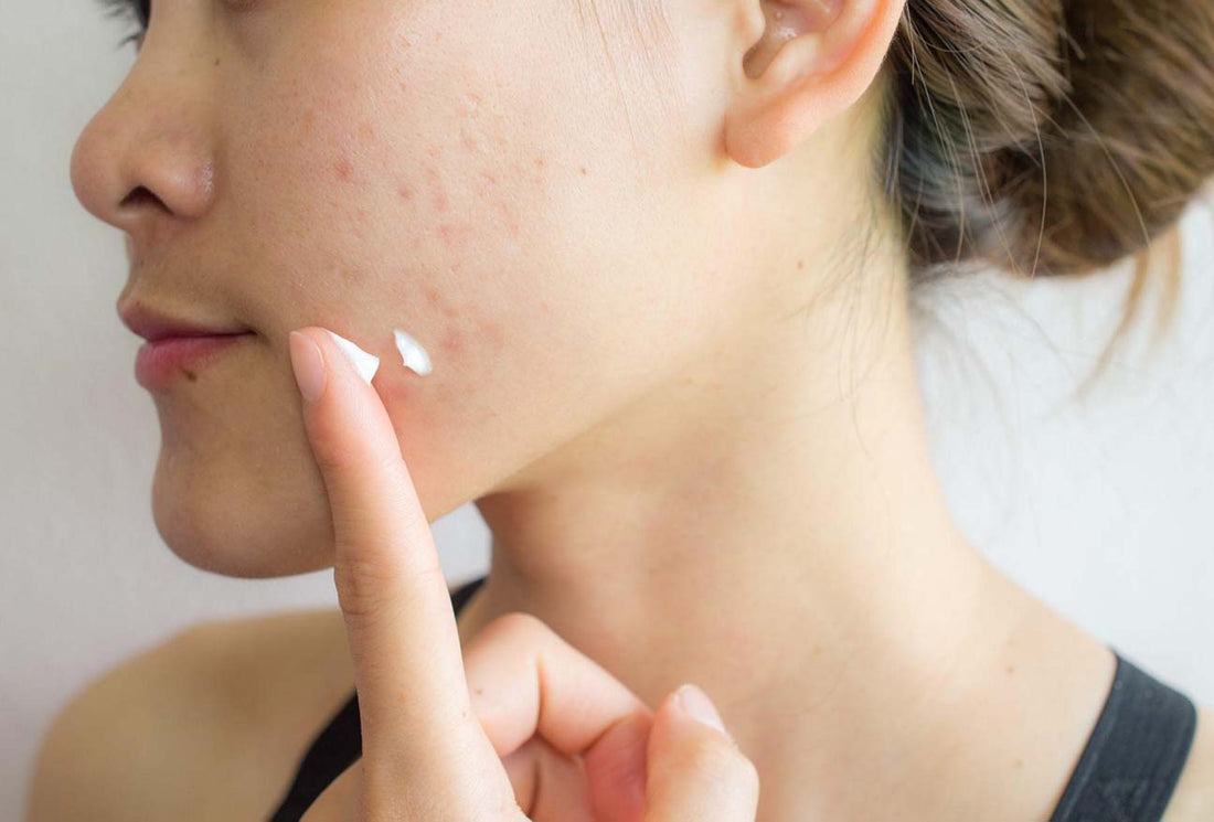 From Scars to Smoothness: How to Use Mederma on Your Face Effectively
