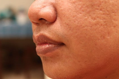 How to Treat Ice Pick Scars at Home: Effective Scar Cream Solutions for Smoother Skin