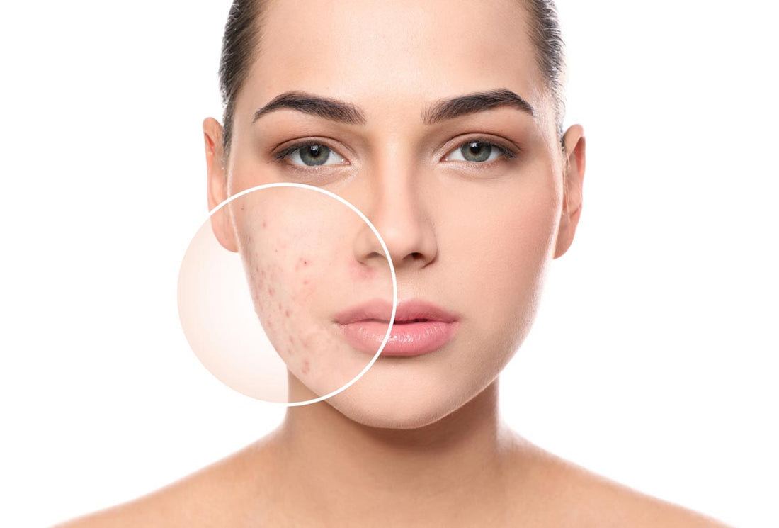 Discover the Best Scar Removal Cream: Top Picks for Smooth, Clear Skin