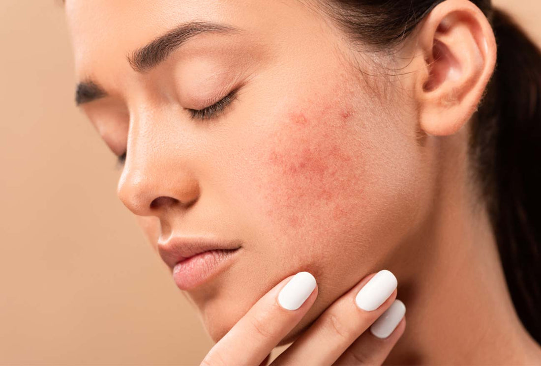 Effective Solutions for Treating Deep Scars on the Face