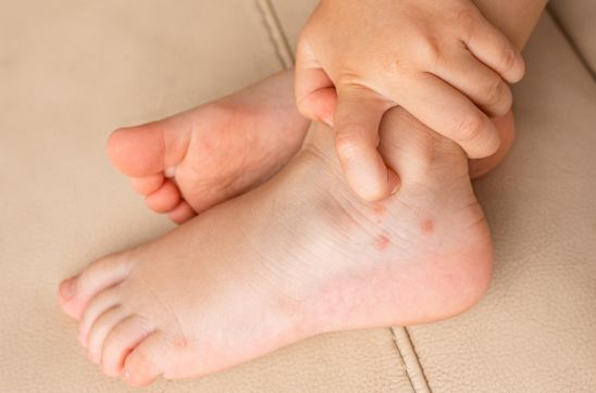 Mosquito Bite Scars: How to Get Rid of Them Effectively