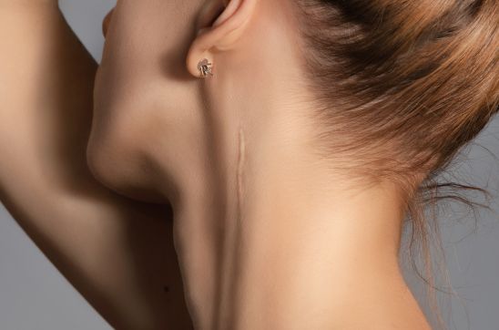 Neck Scars: Causes, Types & Best Ways to Remove or Reduce Them