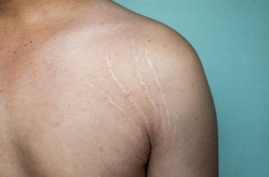 Stretch Marks in Men: Causes, Prevention, and Effective Treatments