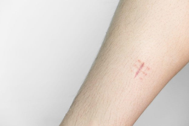How to Remove Stitch Marks: Tips for Reducing Scars After Surgery