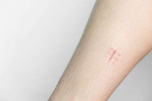 How to Remove Stitch Marks: Tips for Reducing Scars After Surgery