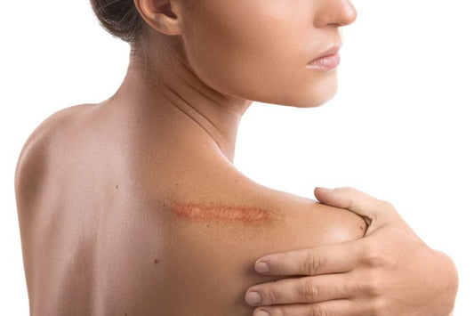 Scar Tissue Meaning: What it is and How it Affects Your Skin and Body