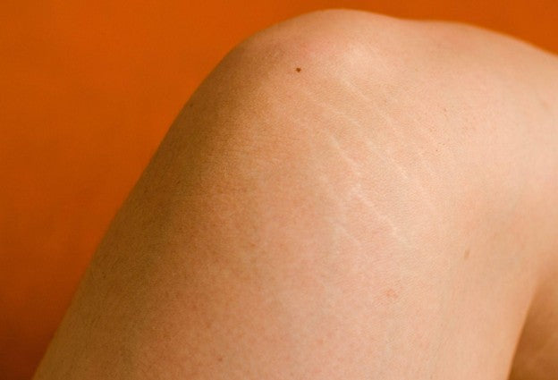 Stretch Marks on Knees: Causes and the Best Ways to Minimise Them