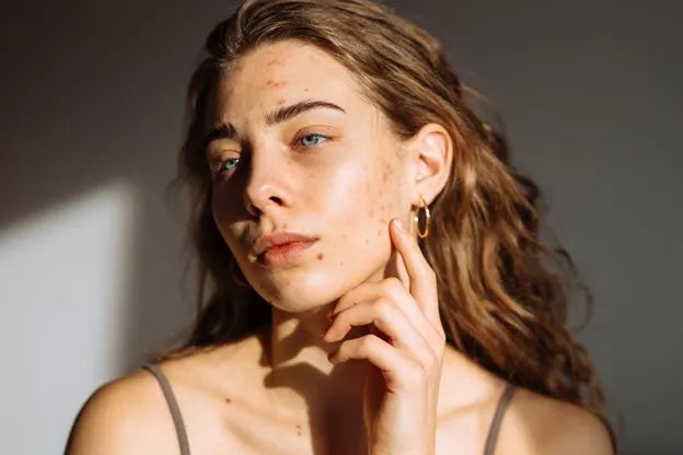 Say Goodbye to Red Acne Scars: Skincare Tips That Work