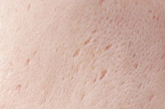What are Rolling Scars? Causes, Types, and How They Form