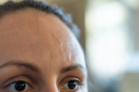 Scar on Forehead: Causes, Treatments & Prevention