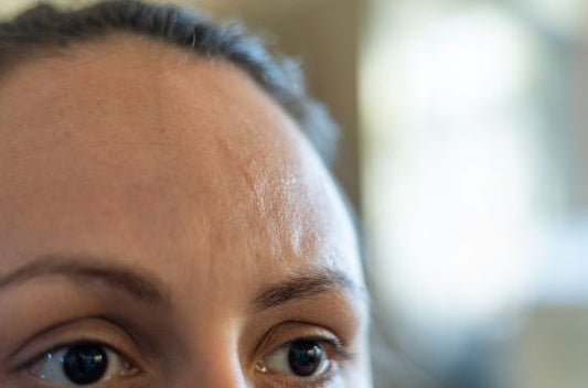 Scar on Forehead: Causes, Treatments & Prevention