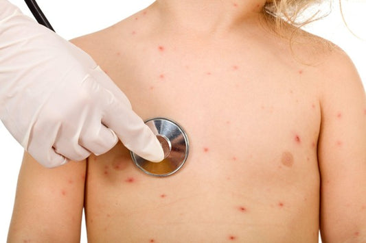 Can You Remove Smallpox Scars? Exploring Treatment Options