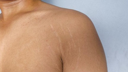How to Treat Stretch Marks on Armpits: Causes, Treatments & Prevention
