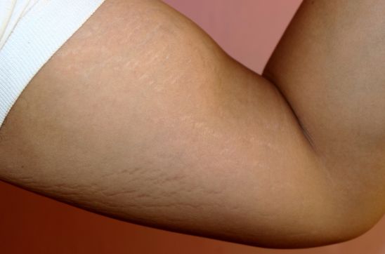 Stretch Marks on Biceps: Causes, Prevention, and Treatment