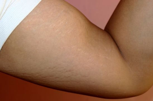 Stretch Marks on Biceps: Causes, Prevention, and Treatment