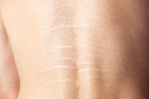 What are Stretch Marks on the Back, and Why Do They Occur?
