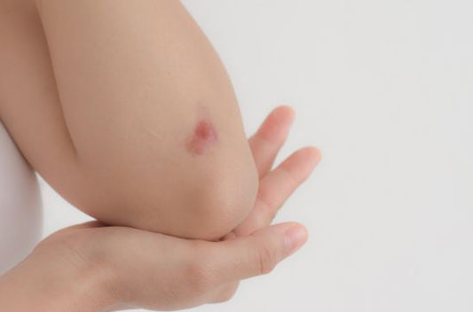 Types of Scars: How to Identify and Treat Each Scar Type
