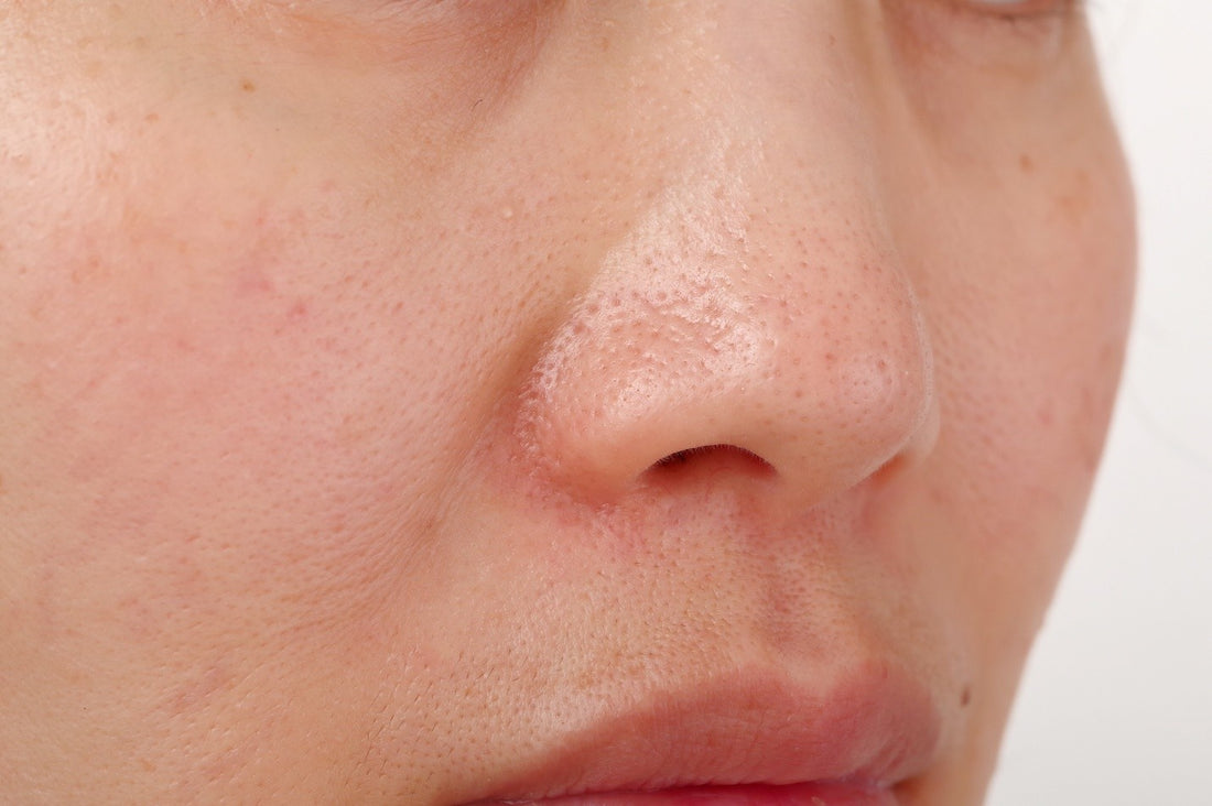 What are Open Pores on the Face? Causes and Treatments