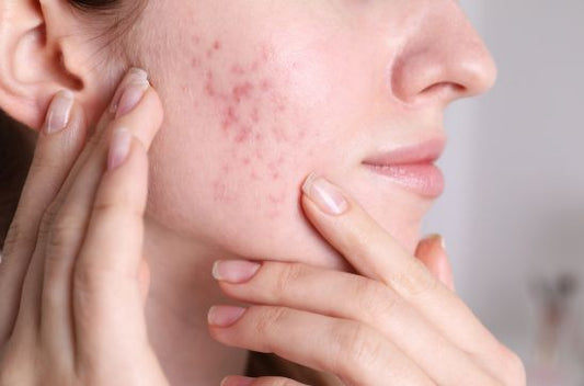 Not Just for Scars! 5 Genius Ways to Use Mederma You Haven’t Tried