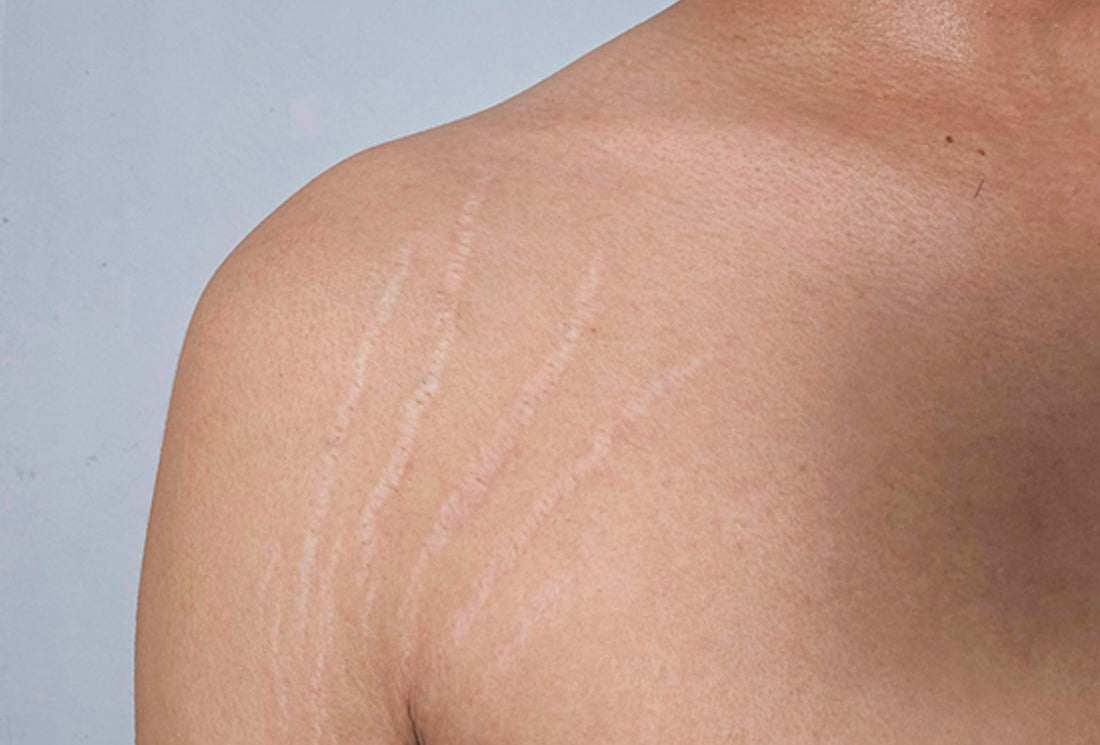 Are Gym Stretch Marks Inevitable? Here’s What You Need to Know