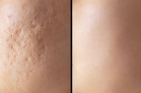 Scar Treatment for All Ages: Teens, Moms & Grandparents—Tailored Advice for Every Generation