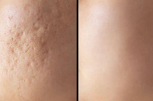 Scar Treatment for All Ages: Teens, Moms & Grandparents—Tailored Advice for Every Generation