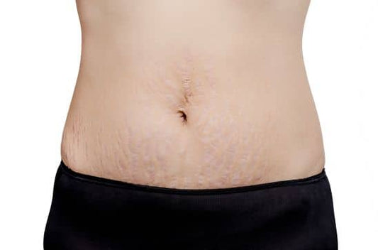 Scars After Weight Loss: Loose Skin, Stretch Marks & Body Confidence