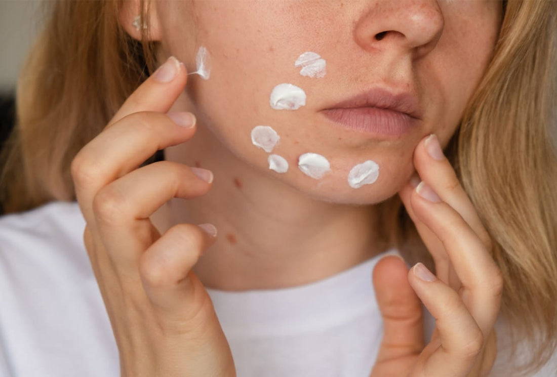 Clear Up the Confusion: Acne Marks vs. Acne Scars