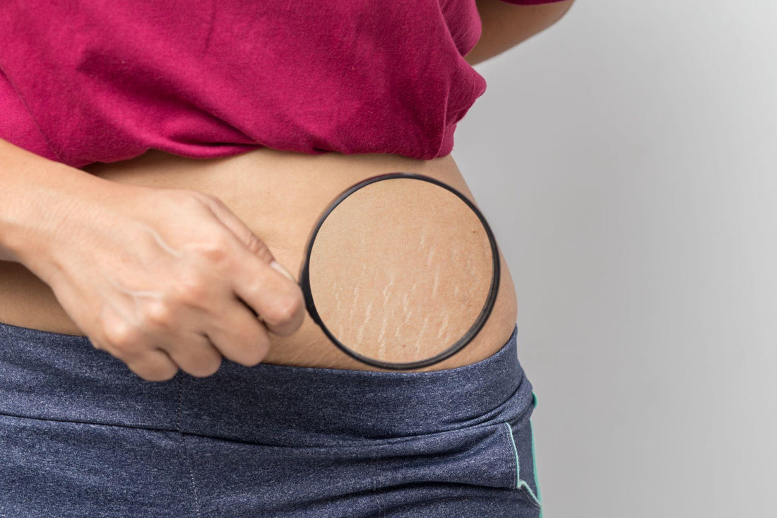 Dealing with Stretch Marks After Weight Loss: What You Need to Know