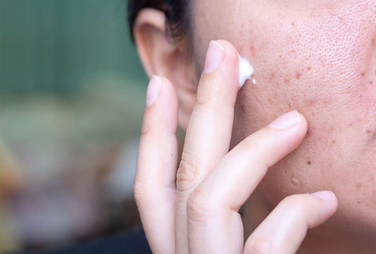 Difference Between Acne and Pigmentation: A Complete Guide