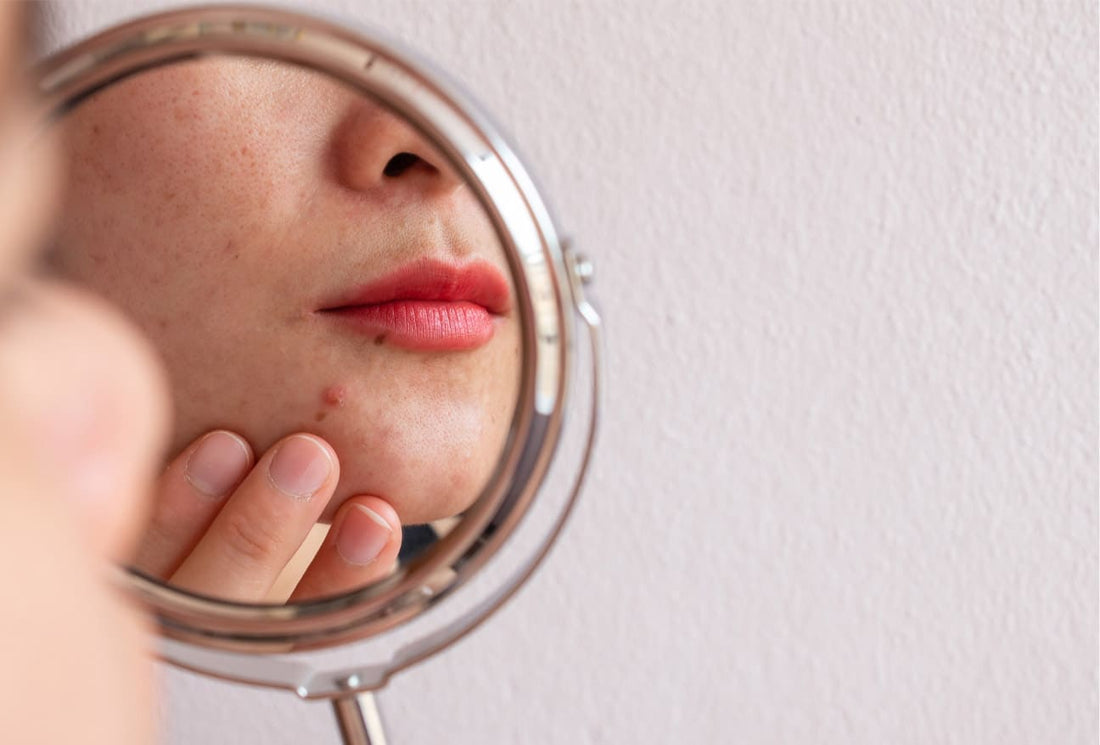 Difference Between Acne and Pimple: Know it All Here