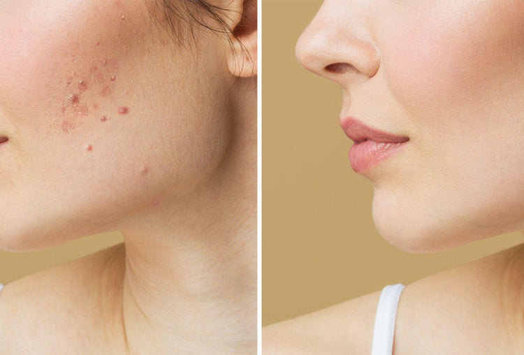 Do Acne Scars Go Away Or Are They Permanent Mederma India do-acne-scars-go-away-or-are-they-permanent-mederma-india