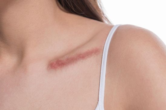 Scar Myths Busted: Fact vs Fiction in Scar Healing