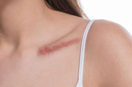 Scar Myths Busted: Fact vs Fiction in Scar Healing