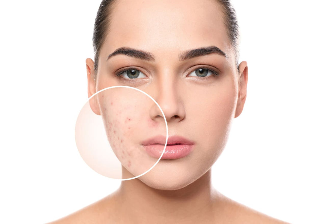 How to Remove Acne Scars Naturally Overnight: What Really Works