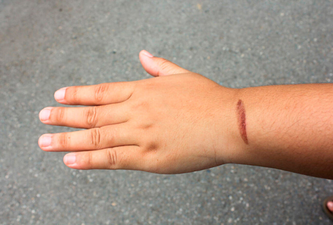 How to Get Rid of Burn Marks: Your Path to Smooth, Beautiful Skin