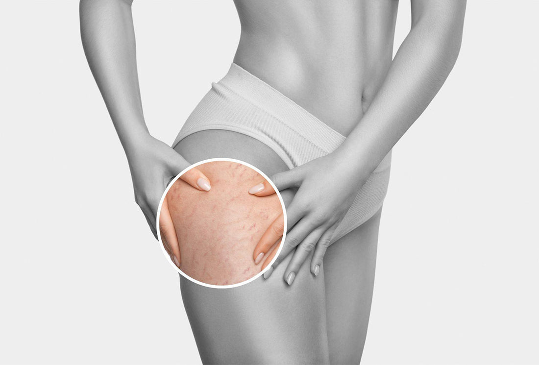 How to Treat Stretch Marks on Your Hips