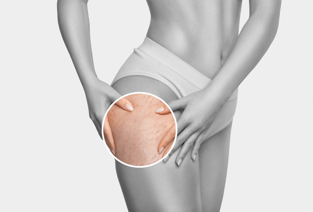 How to Remove Stretch Marks Permanently? Solutions for Everyone