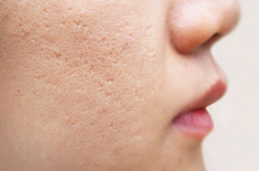 From Old Wives’ Tales to Expert Care: How Scar Treatment Has Evolved in India