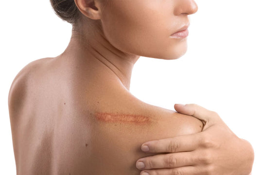 Keloid vs Hypertrophic Scar: Understanding the Difference